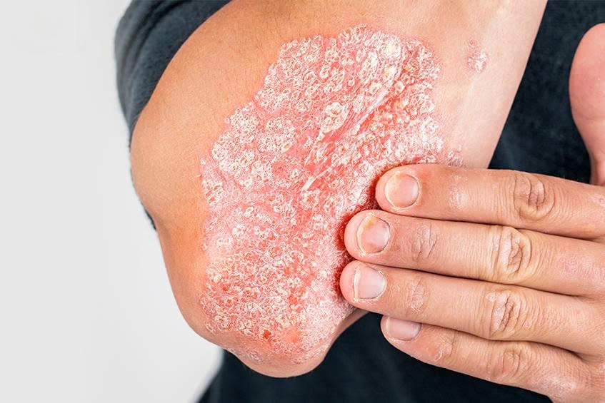 Bệnh vảy nến không đơn thuần chỉ là các tổn thương ngoài da Bệnh vảy nến không đơn thuần chỉ là các tổn thương ngoài da