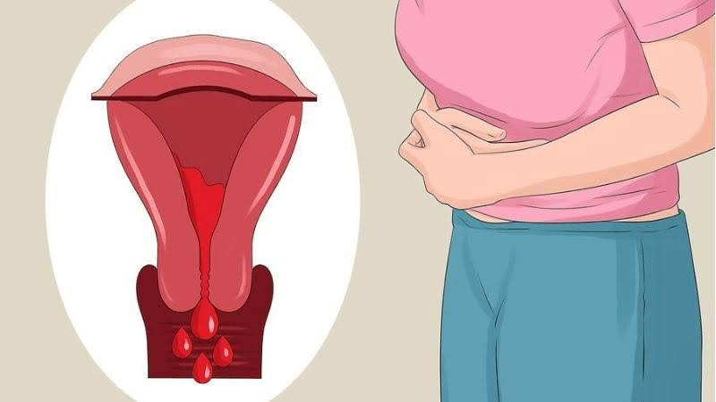 Mức prostaglandin càng cao, cơn đau bụng kinh càng dữ dội