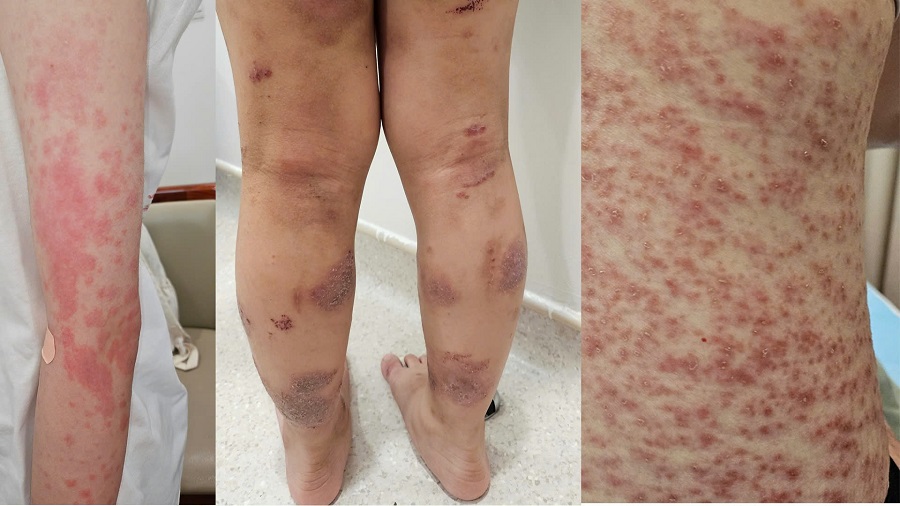 Trường hợp các bệnh liên quan đến dị ứng đến thăm khám tại Vinmec Trường hợp các bệnh liên quan đến dị ứng đến thăm khám tại Vinmec