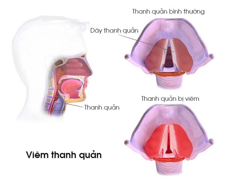 Viêm thanh quản là tình trạng phổ biến ở người “làm nghề” nói nhiều Viêm thanh quản là tình trạng phổ biến ở người “làm nghề” nói nhiều