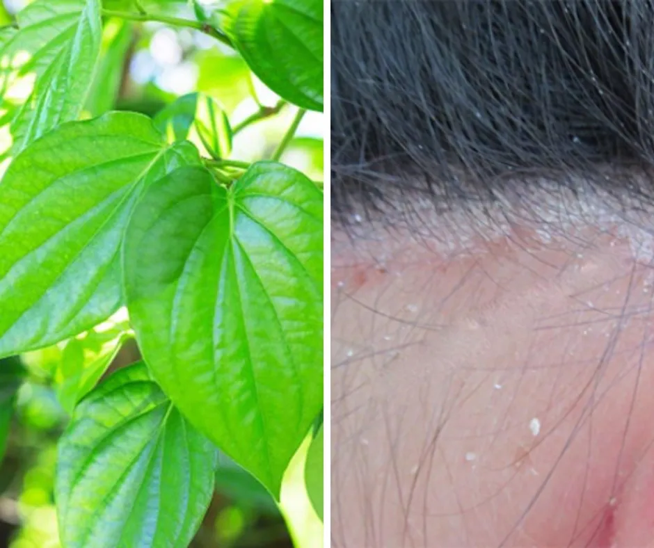 Lá trầu không giúp làm dịu triệu chứng vảy nến da đầu Lá trầu không giúp làm dịu triệu chứng vảy nến da đầu