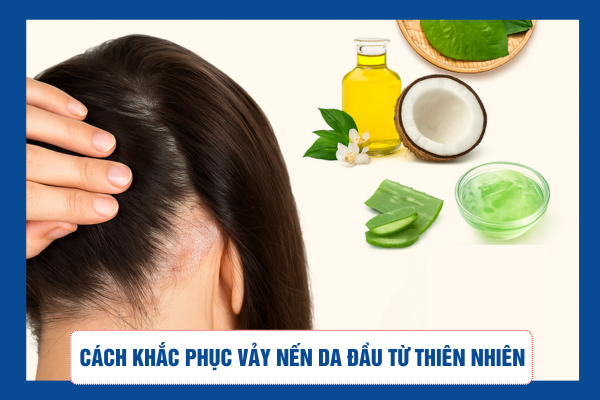 Mách bạn cách khắc phục vảy nến da đầu từ thiên nhiên