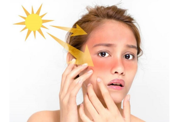 Ánh nắng mặt trời là một trong những nguyên nhân gây nám da