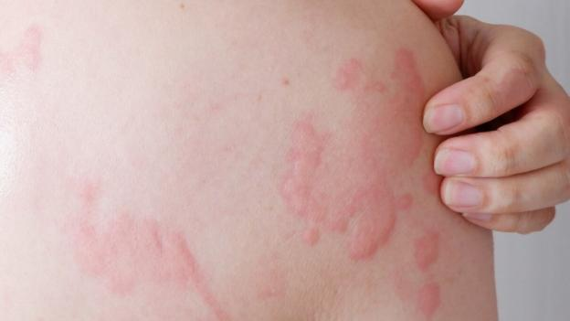 Mẩn ngứa vào mùa hè thường diễn biến dai dẳng. Mẩn ngứa vào mùa hè thường diễn biến dai dẳng.