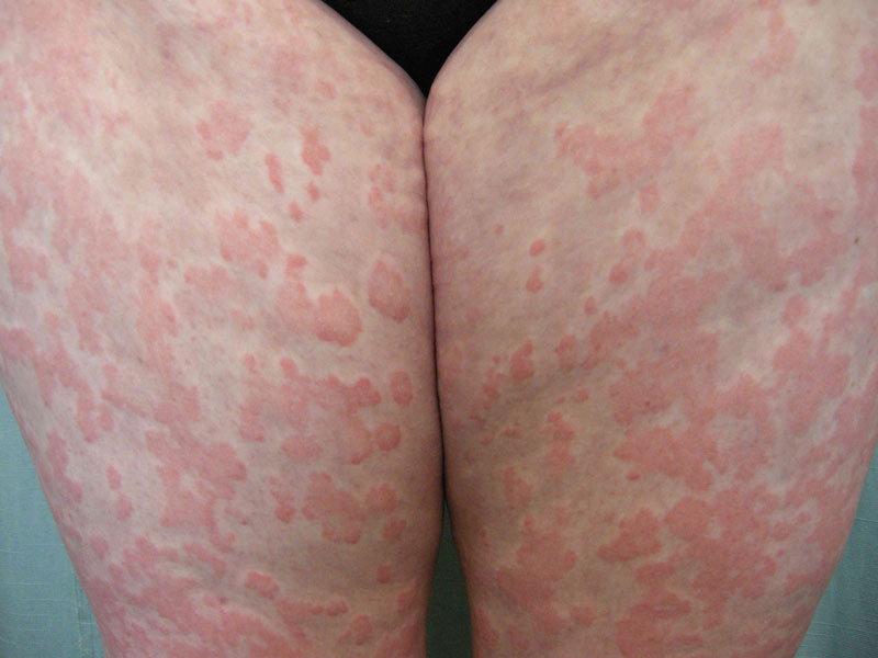 Mẩn ngứa mùa hè: Nguyên nhân thường gặp và giải pháp hỗ trợ từ thảo dược