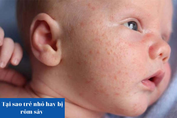 Tại sao trẻ nhỏ hay bị rôm sảy?