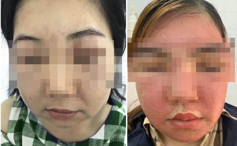 Nhiều bệnh nhân bị biến chứng sau khi tiêm tế bào gốc (Ảnh: Bệnh viện Da liễu TP. Hồ Chí Minh)