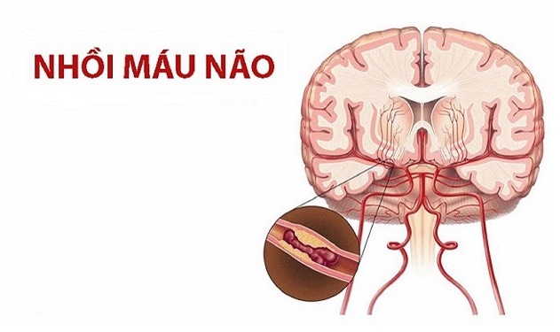 Nhồi máu não xảy ra khi dòng máu tới não bị tắc nghẽn bởi cục máu đông Nhồi máu não xảy ra khi dòng máu tới não bị tắc nghẽn bởi cục máu đông