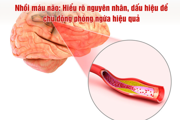 Nhồi máu não: Hiểu rõ nguyên nhân, dấu hiệu để chủ động phòng ngừa hiệu quả