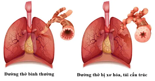 Tái cấu trúc đường thở khiến người bệnh phải đối mặt với tình trạng ho khan kéo dài, dai dẳng Tái cấu trúc đường thở khiến người bệnh phải đối mặt với tình trạng ho khan kéo dài, dai dẳng