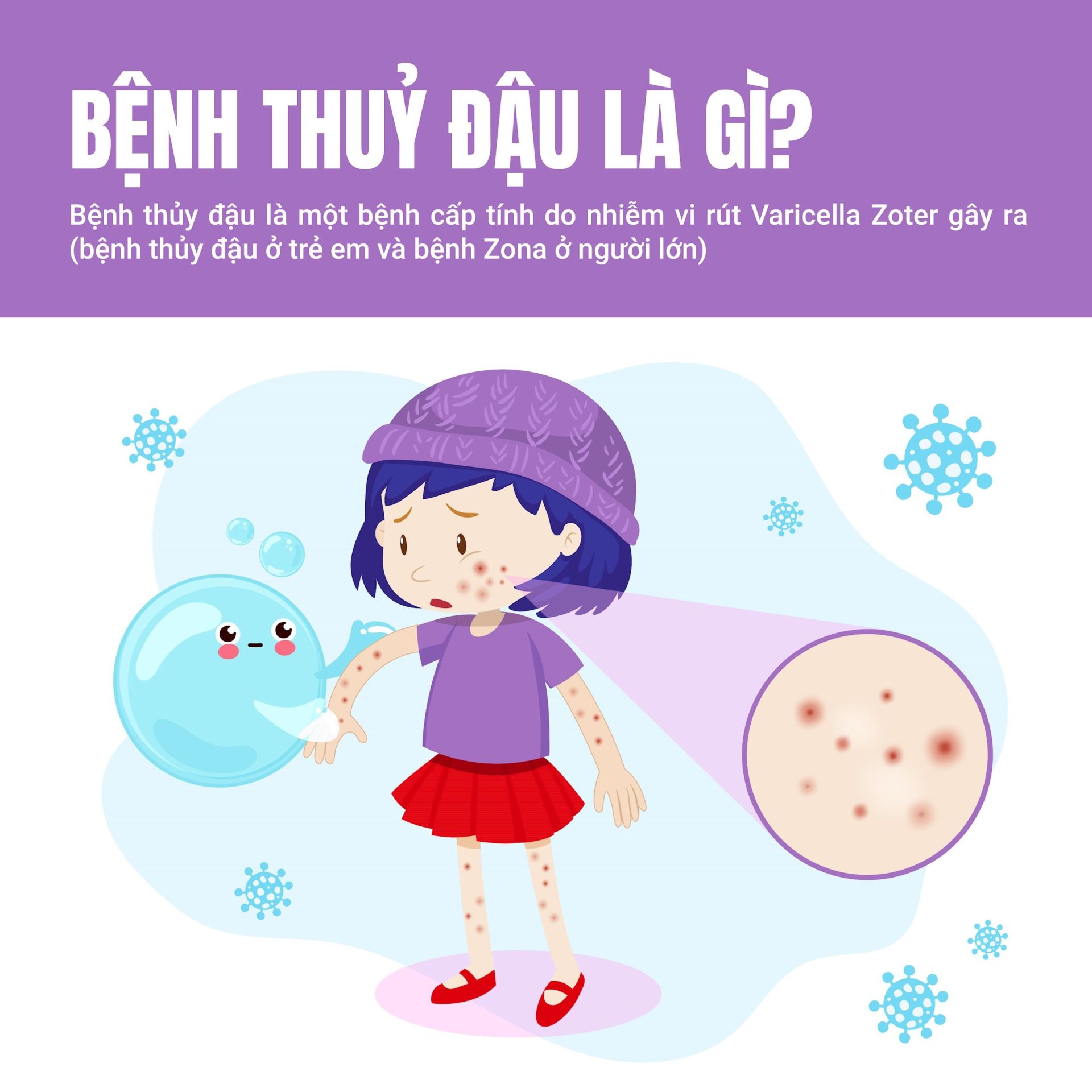 Bệnh thủy đậu và những điều cần biết