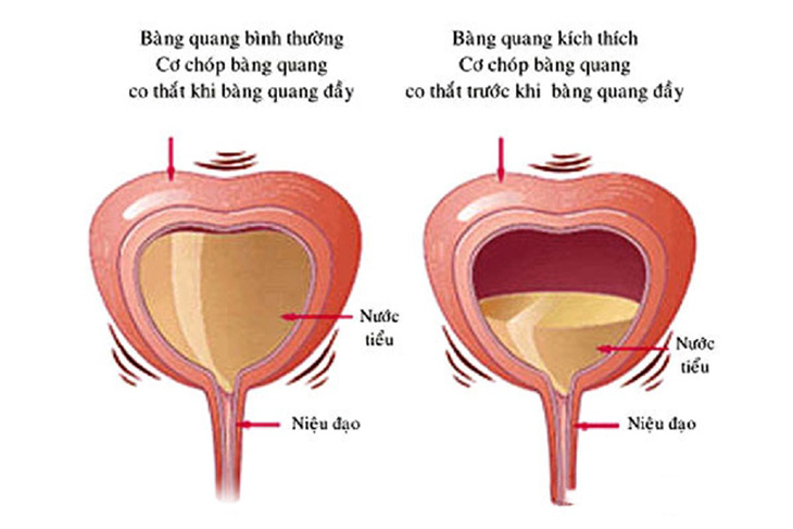 Bàng quang kích thích là nguyên nhân gây tiểu són Bàng quang kích thích là nguyên nhân gây tiểu són