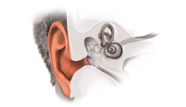 Tuần hoàn tai trong kém là nguyên nhân phổ biến gây ù tai phải Tuần hoàn tai trong kém là nguyên nhân phổ biến gây ù tai phải