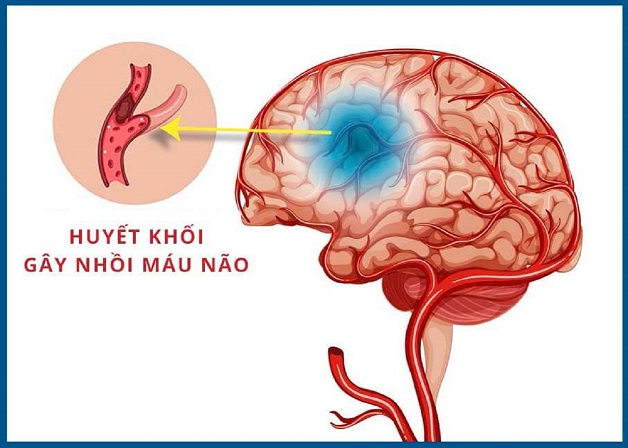 Cục máu đông là nguyên nhân phổ biến gây nhồi máu não