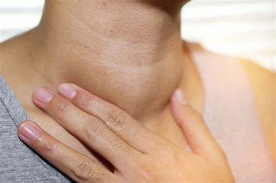 Bướu cổ lành tính là sự phì đại vô hại của tuyến giáp Bướu cổ lành tính là sự phì đại vô hại của tuyến giáp