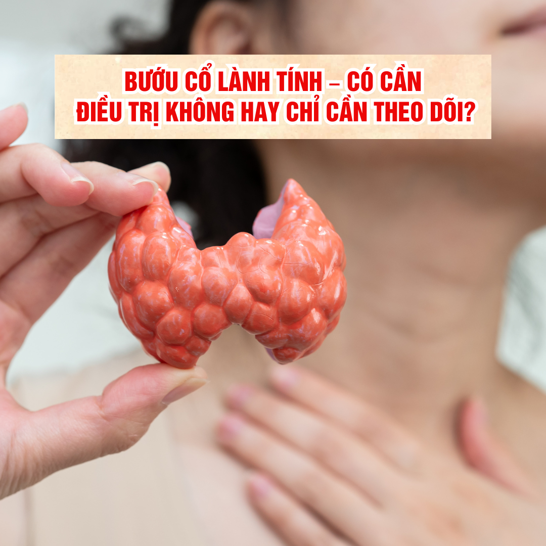 Bướu cổ lành tính – Có cần điều trị không hay chỉ cần theo dõi?