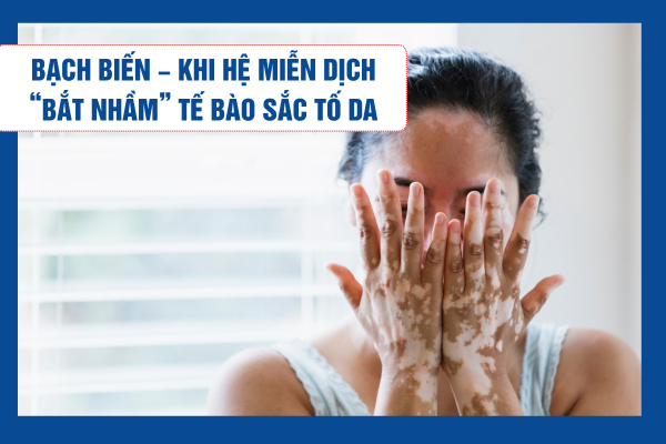 Bạch biến – Khi hệ miễn dịch “bắt nhầm” tế bào sắc tố da