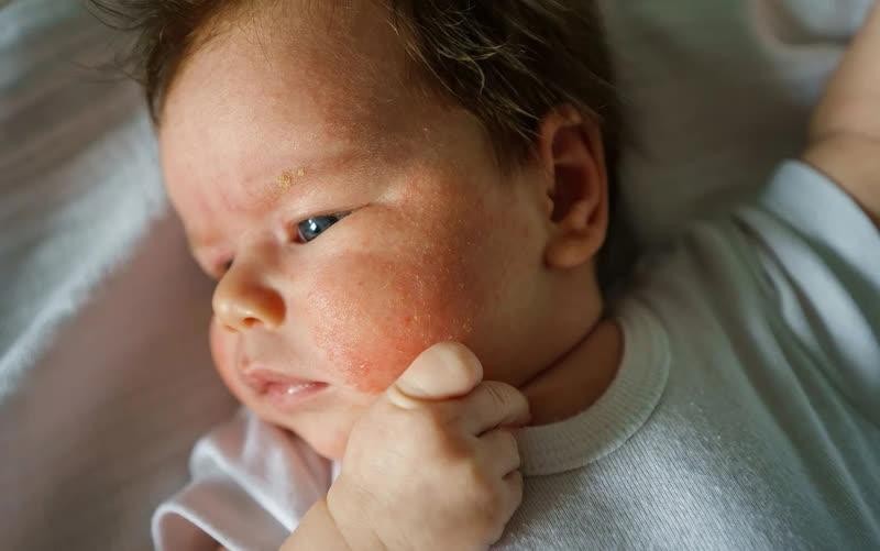 Tổn thương do viêm da khiến trẻ ngứa ngáy, khó chịu.