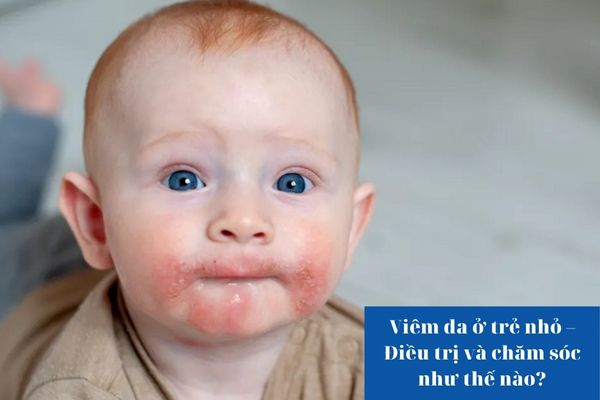 Viêm da ở trẻ nhỏ – Điều trị và chăm sóc như thế nào?