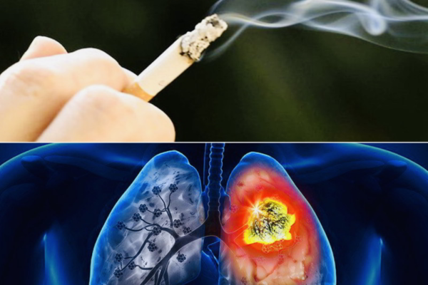 Hút thuốc lá là yếu tố hàng đầu gây u phổi Hút thuốc lá là yếu tố hàng đầu gây u phổi