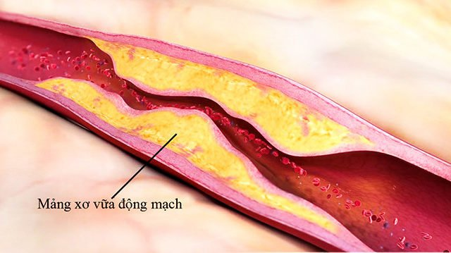 Mảng xơ vữa tích tụ trong động mạch có thể vỡ ra và tạo điều kiện cho cục máu đông hình thành