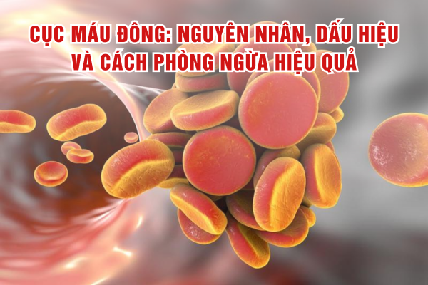 Cục máu đông: Nguyên nhân, dấu hiệu và cách phòng ngừa hiệu quả