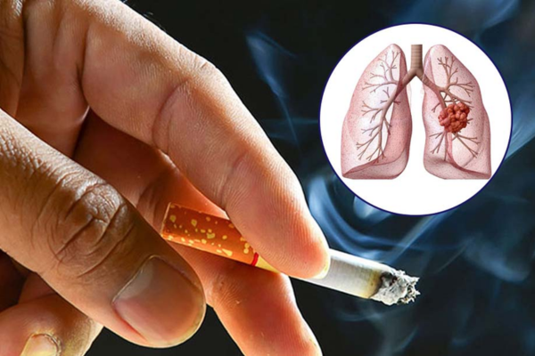 Nguyên nhân gây u phổi và giải pháp cải thiện từ thảo dược