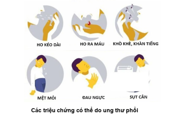Một số triệu chứng u phổi Một số triệu chứng u phổi