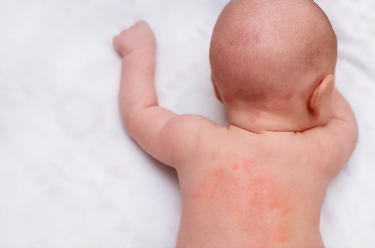 Khi bị rôm sảy lâu ngày, vết thâm và sẹo có thể hình thành