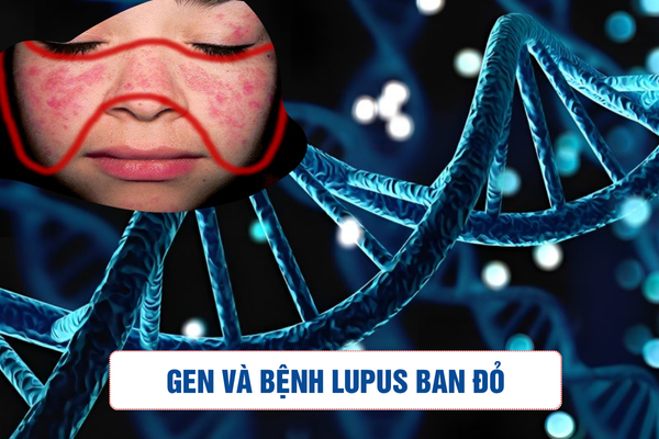 Mối liên hệ giữa gen và lupus ban đỏ: Hiểu đúng để điều trị hiệu quả