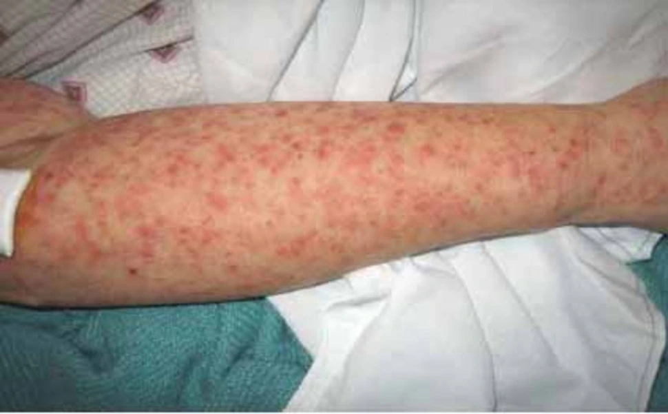 WHO cảnh báo virus Chikungunya có thể gây sốt cao, đau khớp