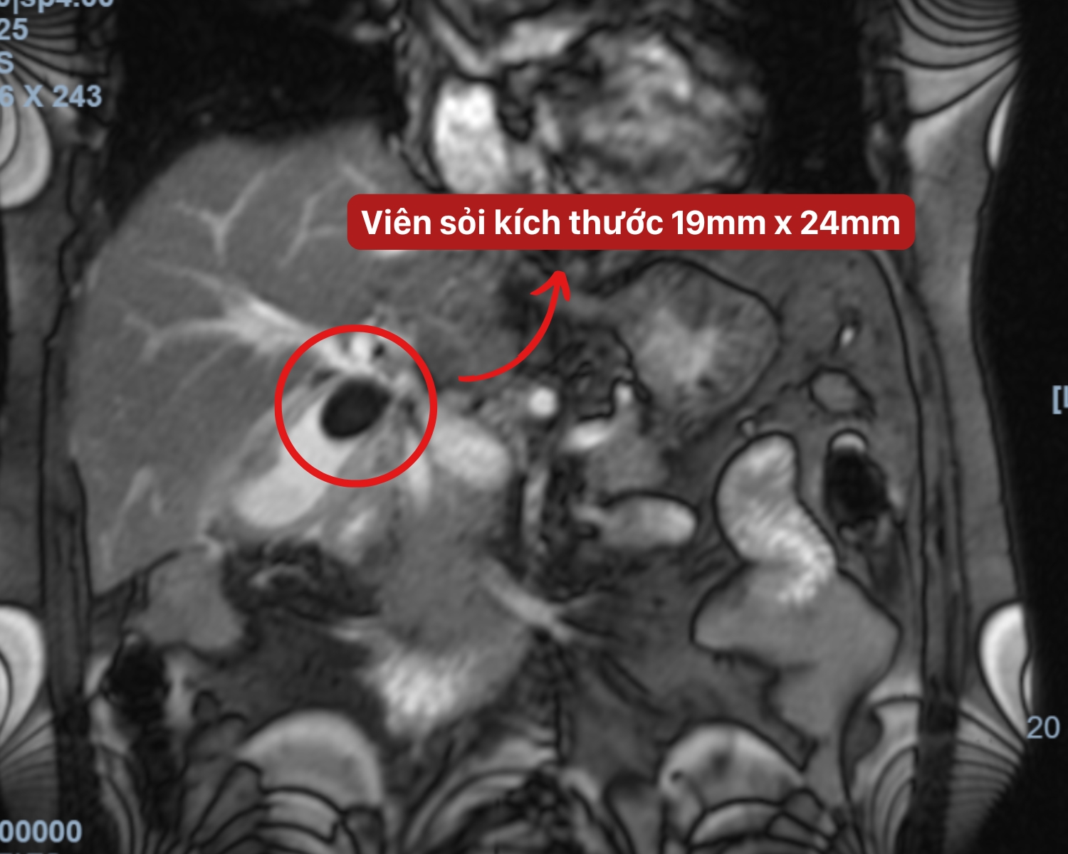 Viên sỏi 2.4 cm gây hoại tử túi mật
