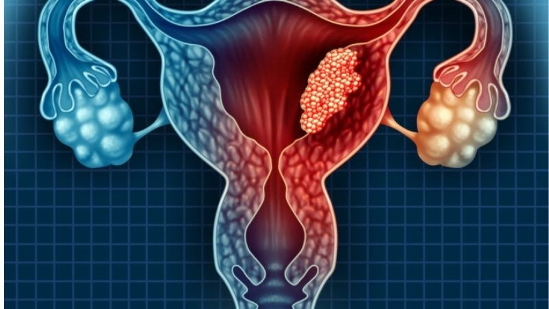 U xơ tử cung có dấu hiệu ác tính thường được chỉ định phẫu thuật