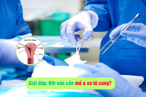Giải đáp: Khi nào cần mổ u xơ tử cung?