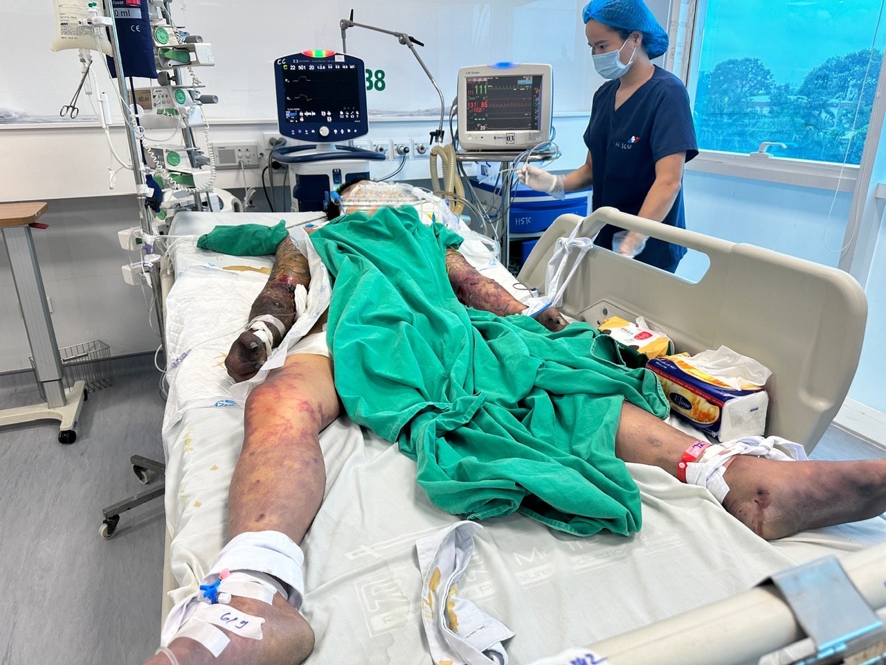Hà Nội ghi nhận 1 người tử vong do mắc liên cầu lợn đầu tiên trong năm