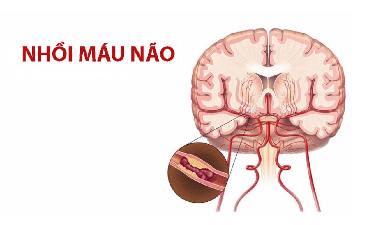 Nhồi máu não xảy ra khi mạch máu trong não bị tắc nghẽn do cục máu đông, gây thiếu oxy cho não