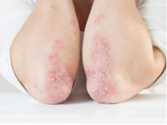 Vảy nến là bệnh tự miễn thường gặp
