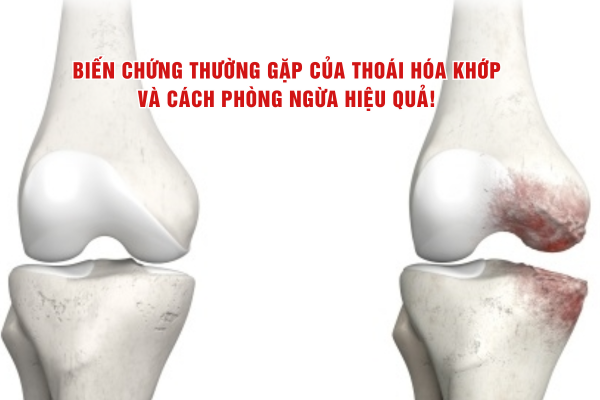 Biến chứng thường gặp của thoái hóa khớp và cách phòng ngừa hiệu quả!