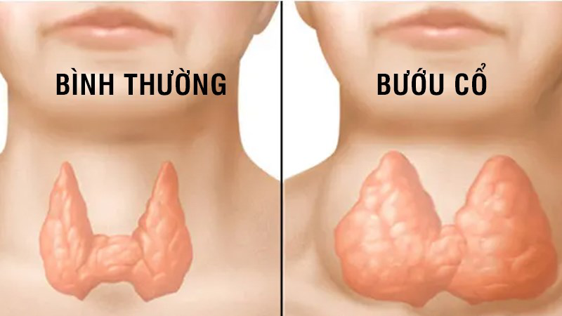 Bướu cổ lành tính là sự gia tăng kích thước bất thường của tuyến giáp