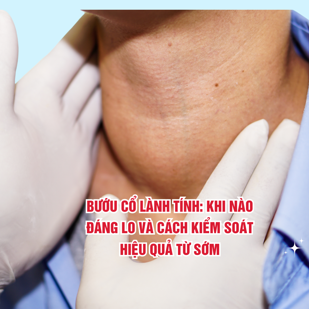 Bướu cổ lành tính: Khi nào đáng lo và cách kiểm soát hiệu quả từ sớm