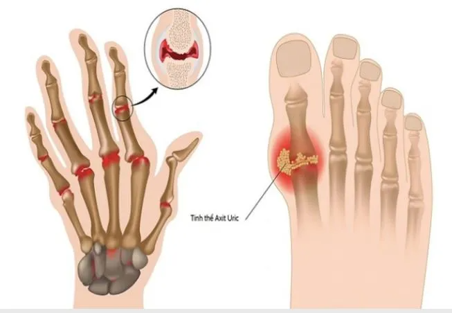 Cảnh báo nồng độ axit uric cao: Đừng chủ quan với 7 dấu hiệu âm thầm