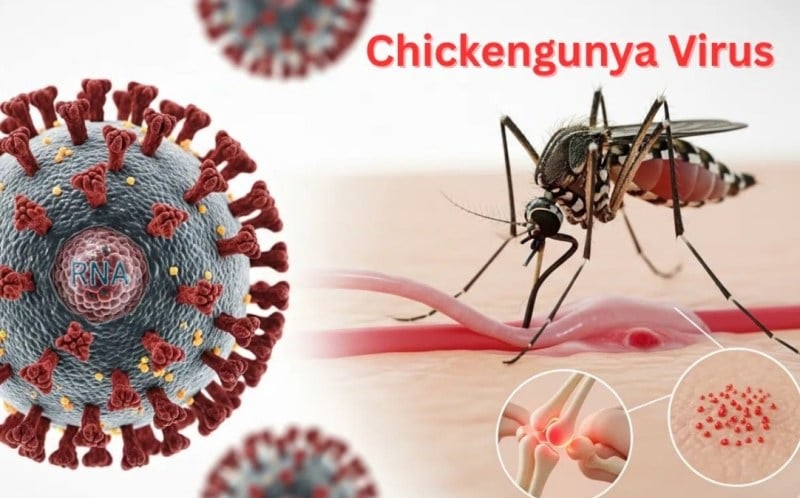 Bệnh Chikungunya dễ bị nhầm lẫn với bệnh khác