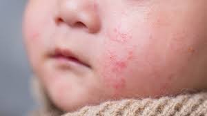 Viêm da rất hay gặp ở trẻ nhỏ