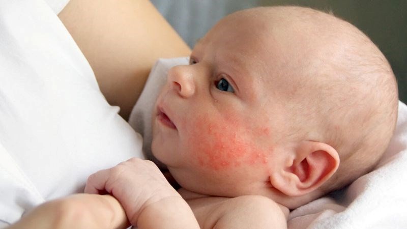 Bé có cơ địa dị ứng có thể bị viêm da