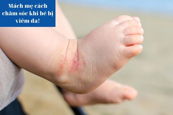 Mách mẹ cách chăm sóc khi bé bị viêm da