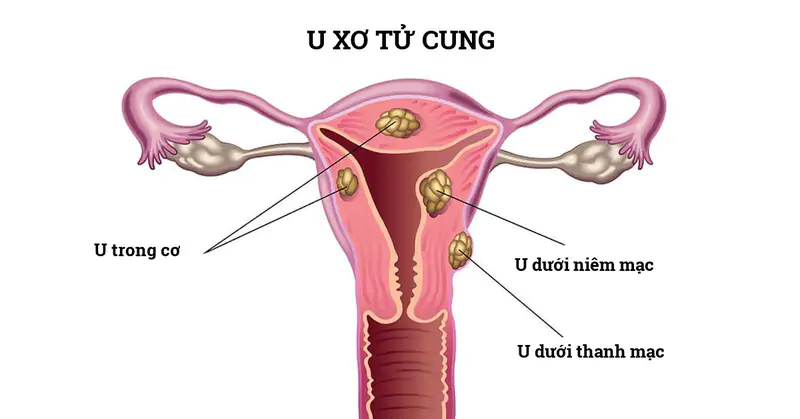 U xơ tử cung dưới niêm mạc là loại nguy hiểm, cần được điều trị sớm U xơ tử cung dưới niêm mạc là loại nguy hiểm, cần được điều trị sớm