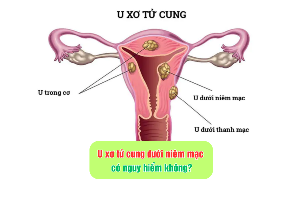 U xơ tử cung dưới niêm mạc có nguy hiểm không?