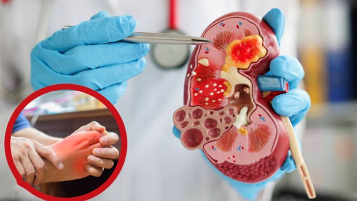 Suy thận là một trong những biến chứng nặng nề của người bệnh gút Suy thận là một trong những biến chứng nặng nề của người bệnh gút