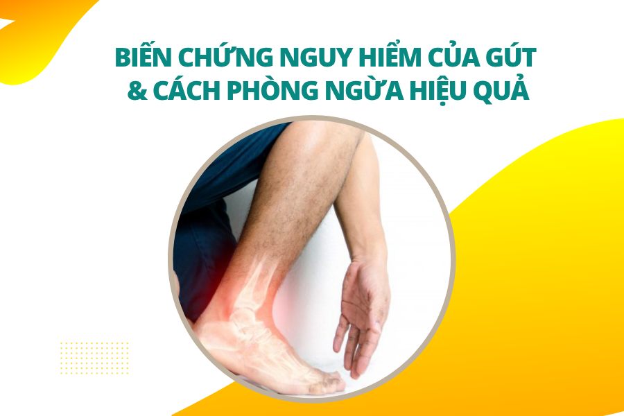 Biến chứng bệnh gút và cách phòng ngừa hiệu quả