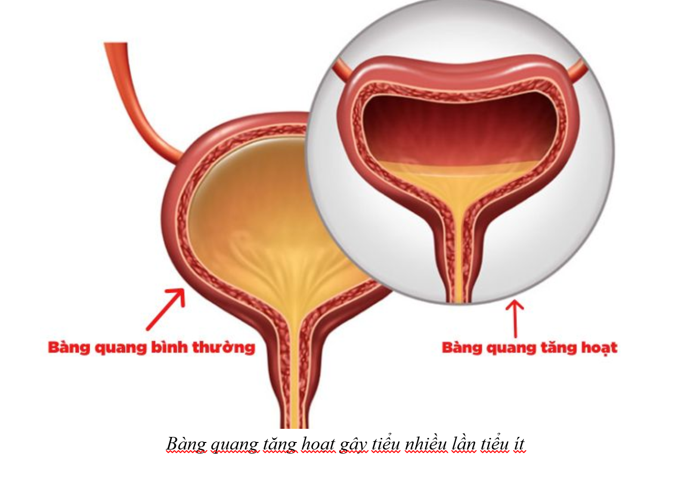 Bàng quang tăng hoạt gây tiểu nhiều lần tiểu ít Bàng quang tăng hoạt gây tiểu nhiều lần tiểu ít